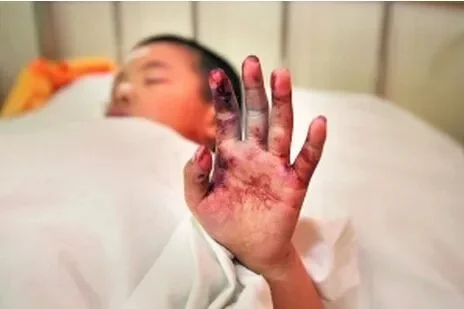 手被火炮炸了怎么办　手被火炮炸了怎么办图片